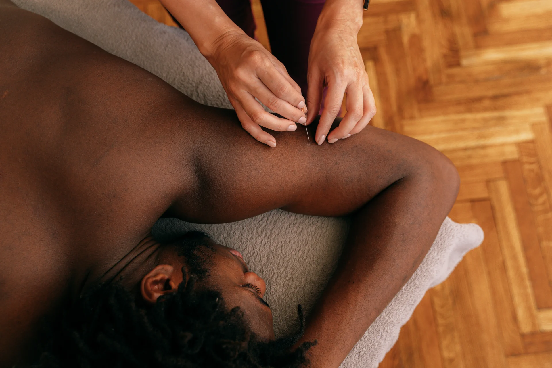 Acupuntura en el brazo de un joven